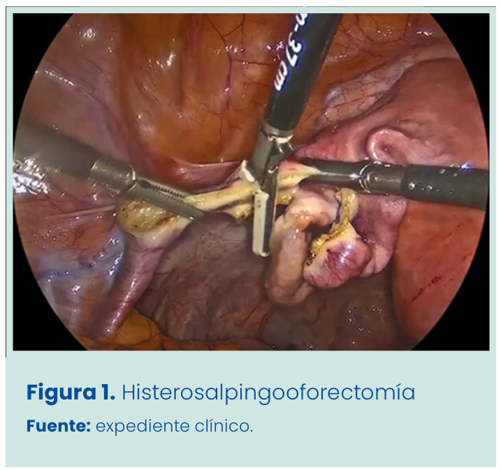 Figura 1. Grapadora lineal vascular aplicada en bloque al pedículo renal.