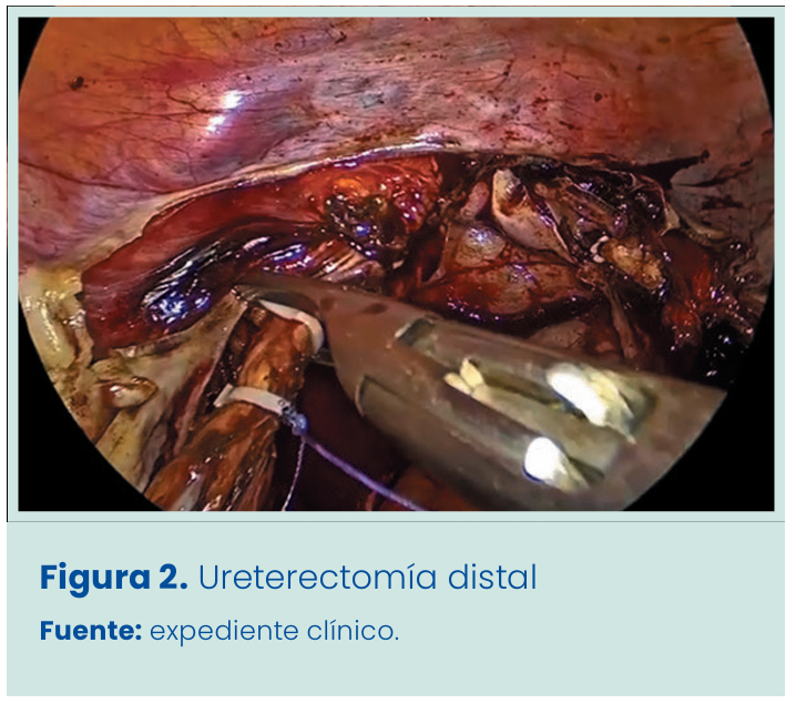 Figura 1. Grapadora lineal vascular aplicada en bloque al pedículo renal.