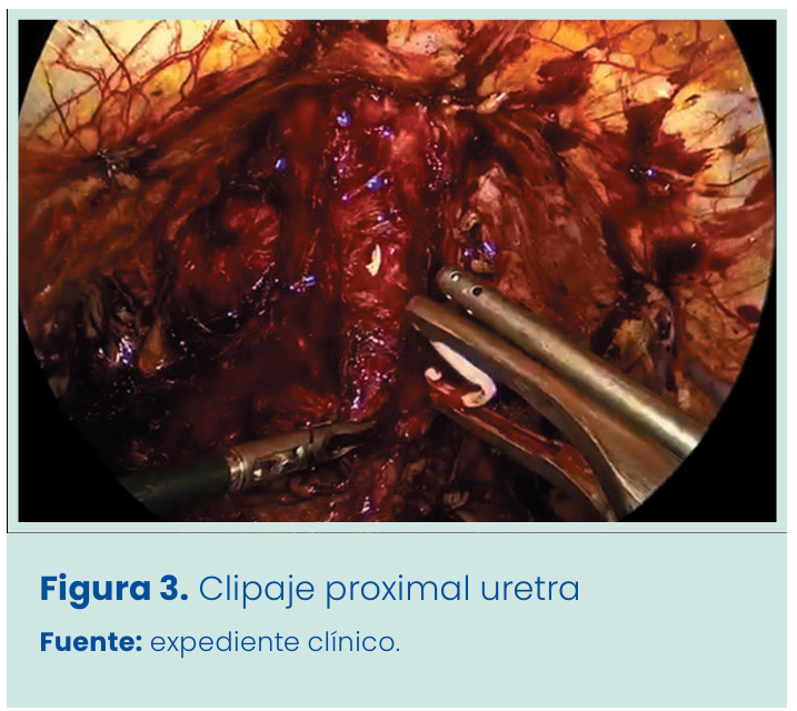 Figura 1. Grapadora lineal vascular aplicada en bloque al pedículo renal.