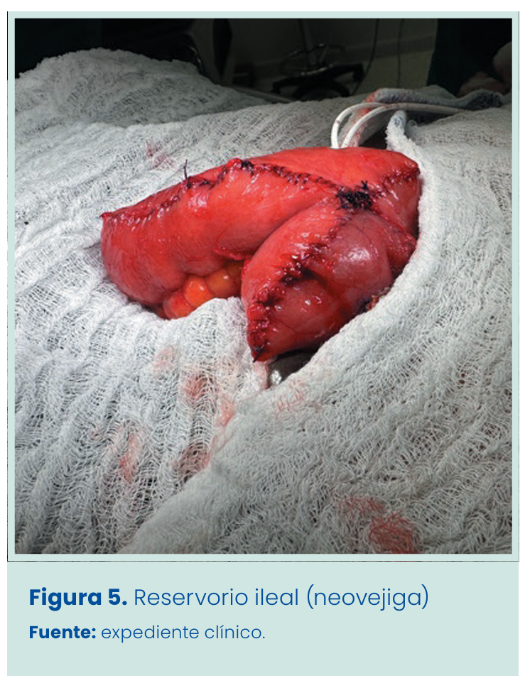 Figura 1. Grapadora lineal vascular aplicada en bloque al pedículo renal.