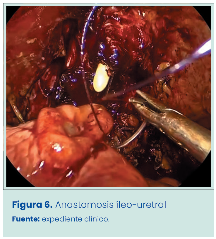 Figura 1. Grapadora lineal vascular aplicada en bloque al pedículo renal.