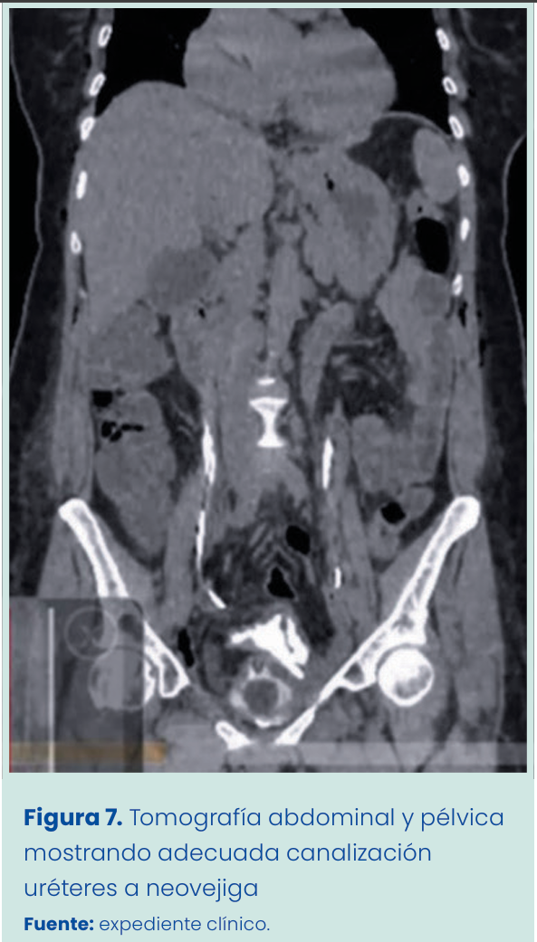 Figura 1. Grapadora lineal vascular aplicada en bloque al pedículo renal.