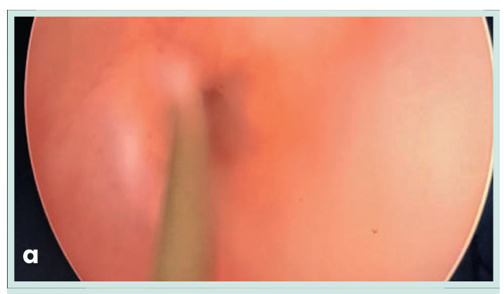 Figura 1. Grapadora lineal vascular aplicada en bloque al pedículo renal.