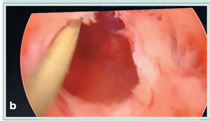 Figura 1. Grapadora lineal vascular aplicada en bloque al pedículo renal.