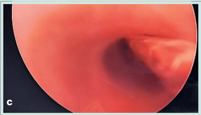 Figura 1. Grapadora lineal vascular aplicada en bloque al pedículo renal.