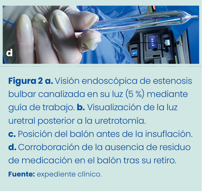 Figura 1. Grapadora lineal vascular aplicada en bloque al pedículo renal.