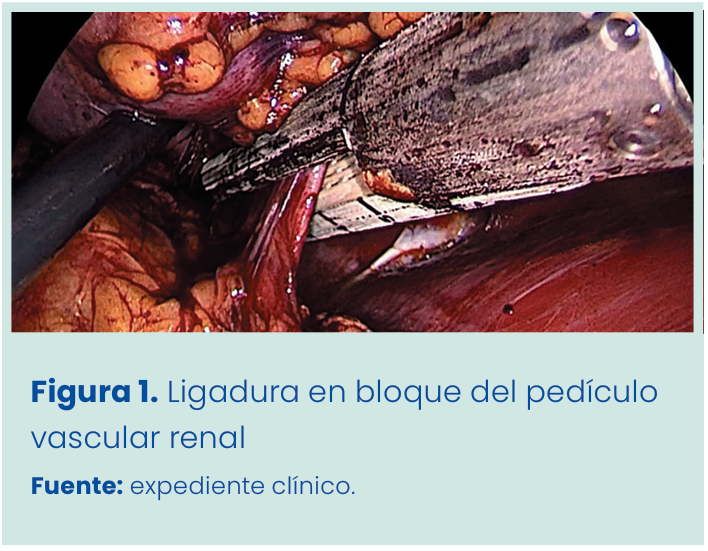 Figura 1. Grapadora lineal vascular aplicada en bloque al pedículo renal.