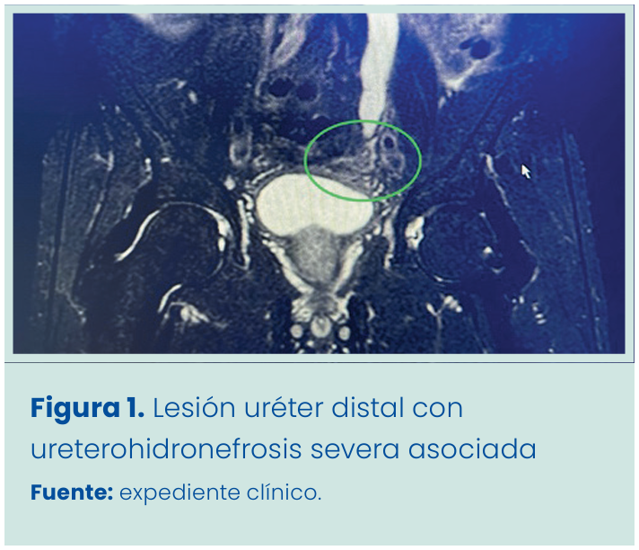 Figura 1. Grapadora lineal vascular aplicada en bloque al pedículo renal.