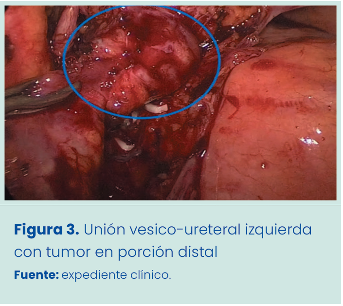 Figura 1. Grapadora lineal vascular aplicada en bloque al pedículo renal.