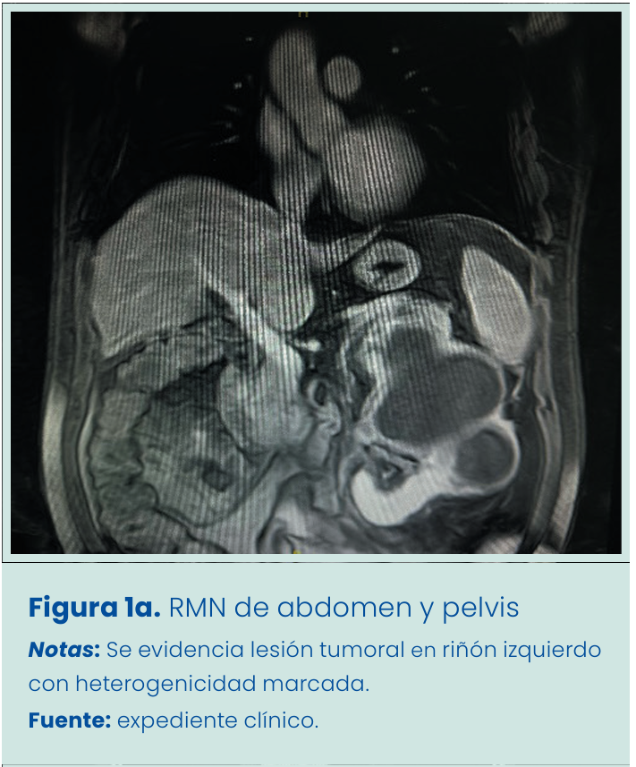 Figura 1. Grapadora lineal vascular aplicada en bloque al pedículo renal.