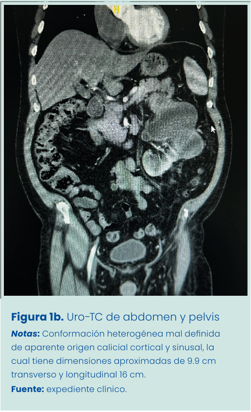 Figura 1. Grapadora lineal vascular aplicada en bloque al pedículo renal.