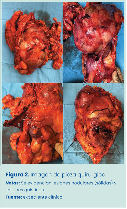 Figura 1. Grapadora lineal vascular aplicada en bloque al pedículo renal.