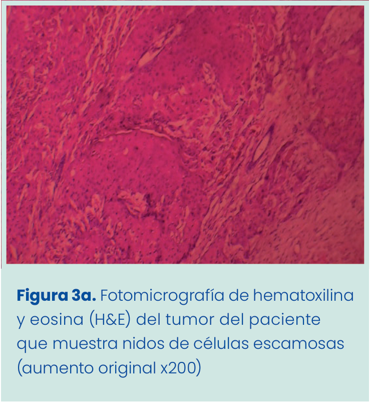 Figura 1. Grapadora lineal vascular aplicada en bloque al pedículo renal.