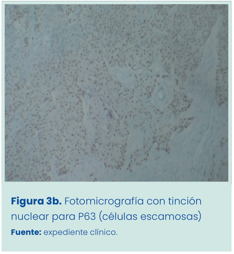 Figura 1. Grapadora lineal vascular aplicada en bloque al pedículo renal.