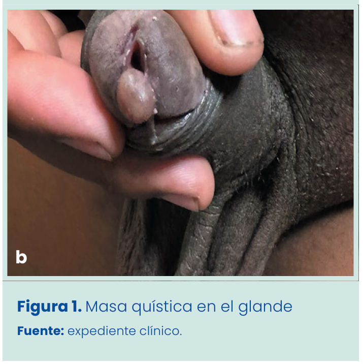 Figura 1. Grapadora lineal vascular aplicada en bloque al pedículo renal.