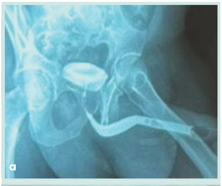 Figura 1. Grapadora lineal vascular aplicada en bloque al pedículo renal.