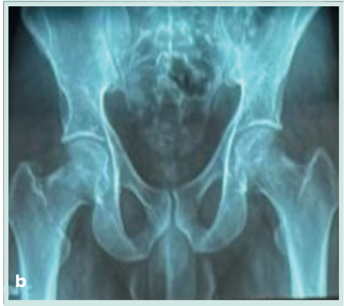 Figura 1. Grapadora lineal vascular aplicada en bloque al pedículo renal.