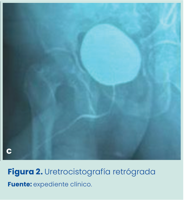 Figura 1. Grapadora lineal vascular aplicada en bloque al pedículo renal.