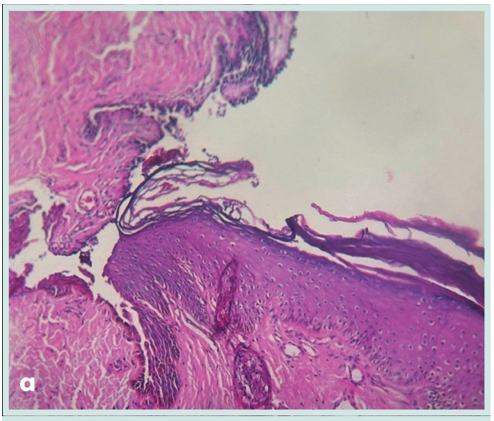 Figura 1. Grapadora lineal vascular aplicada en bloque al pedículo renal.