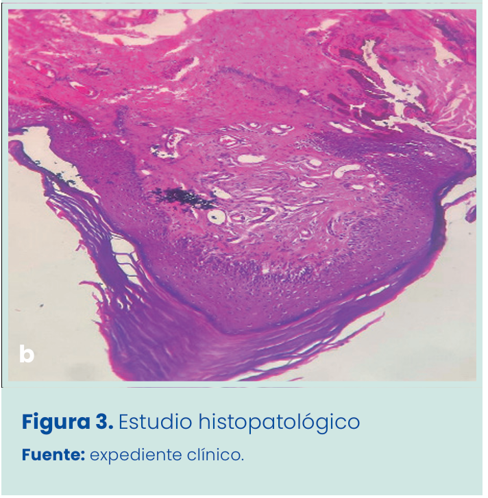 Figura 1. Grapadora lineal vascular aplicada en bloque al pedículo renal.