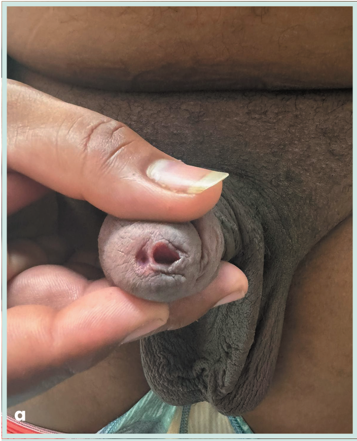 Figura 1. Grapadora lineal vascular aplicada en bloque al pedículo renal.