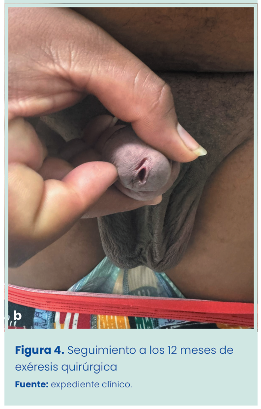 Figura 1. Grapadora lineal vascular aplicada en bloque al pedículo renal.