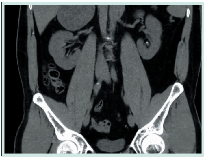 Figura 1. Grapadora lineal vascular aplicada en bloque al pedículo renal.