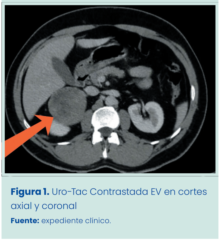 Figura 2. Grapadora lineal vascular aplicada en bloque al pedículo renal.