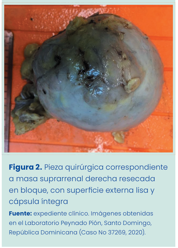 Figura 2. Grapadora lineal vascular aplicada en bloque al pedículo renal.
